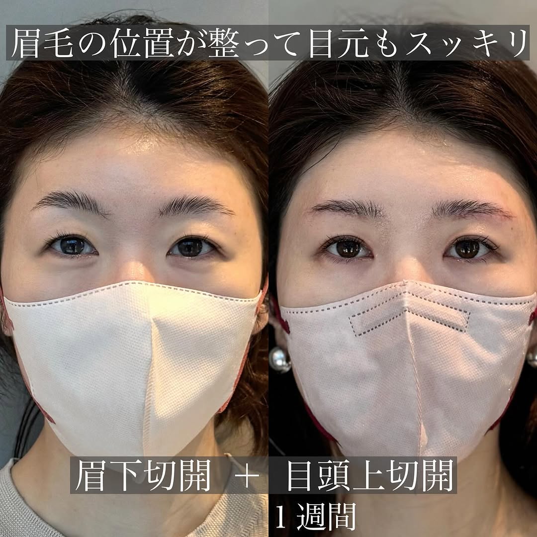 眉下切開＋目頭上切開でまぶたを全体的にすっきりさせた症例（術後1週間） 画像3