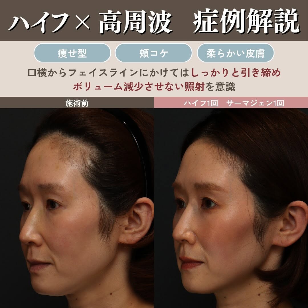 ハイフ×高周波（サーマZI）を組み合わせるメリット｜全層に熱を加える立体たるみ治療 画像4