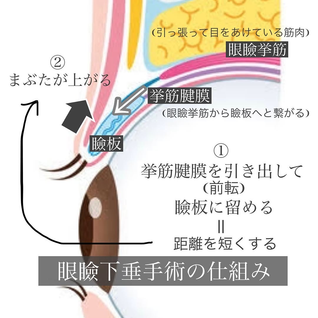 眼瞼下垂手術で黒目の見える範囲が広がり目に入る光が増えた症例（術後1ヶ月） 画像3