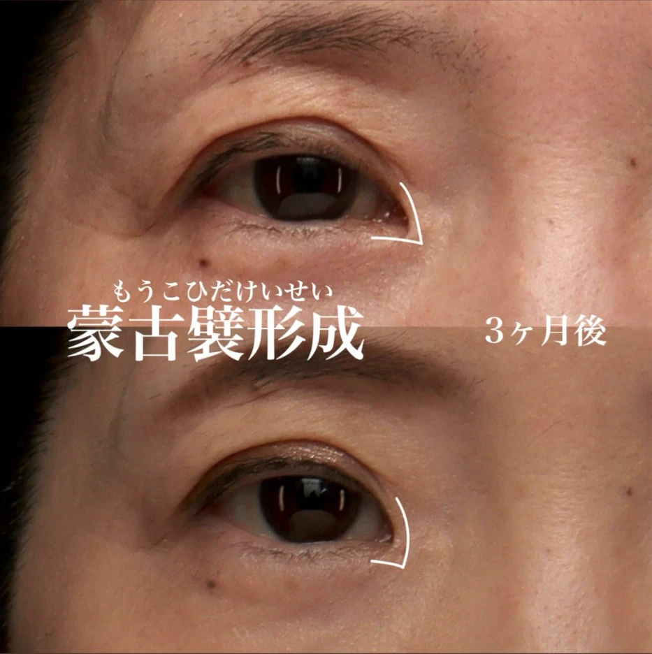 他院蒙古襞形成後の再手術で目頭の角度を柔らかくし優しい印象にした症例(術後3ヶ月)