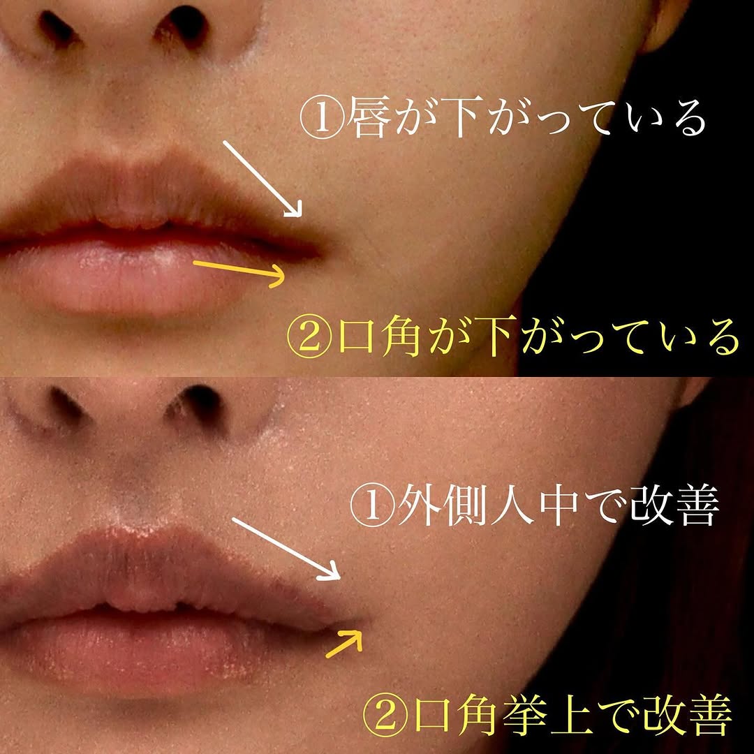 他院人中短縮後の口角挙上＋外側人中で唇全体のバランスを整えた症例 画像4