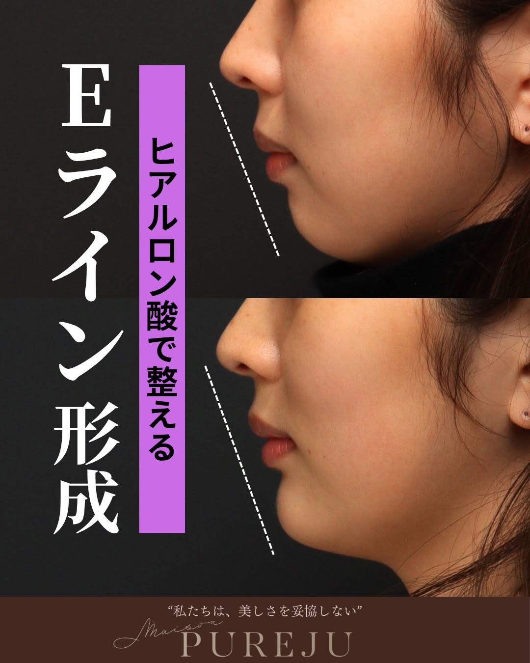 Eライン形成とは｜ヒアルロン酸注入で横顔の美しさを整えるMaison PUREJUの症例と施術