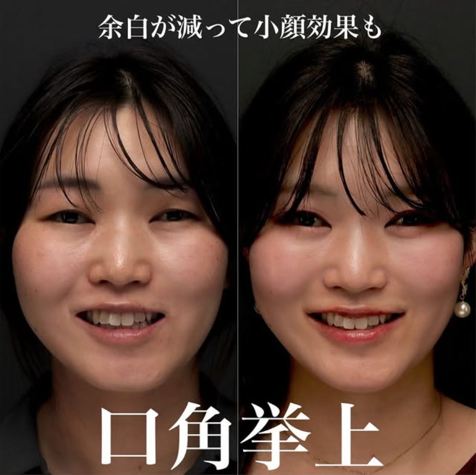 口角挙上で笑いにくさを改善し余白を減らして小顔効果も得られた症例