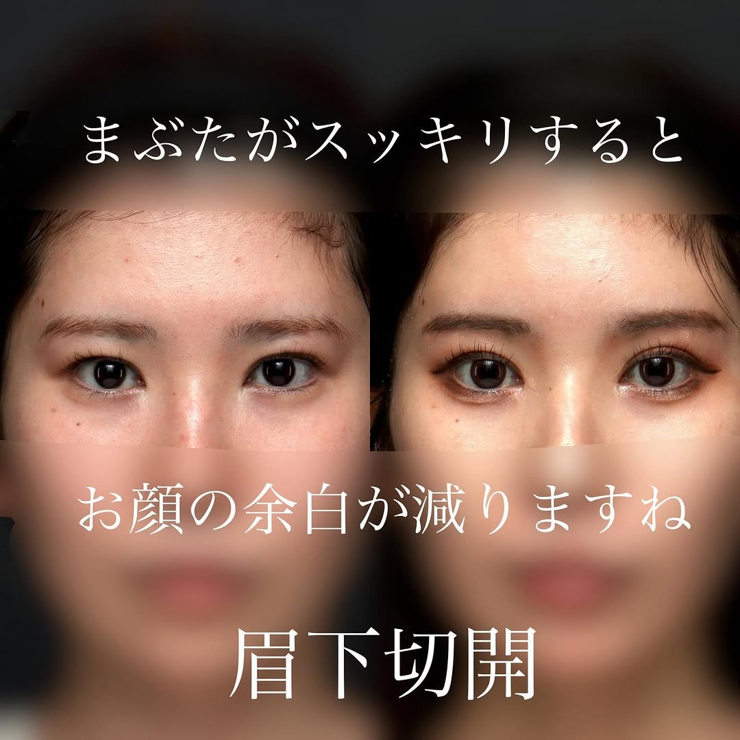 眉下切開でまぶたのもたつきをすっきり改善した症例（術後6ヶ月） 画像2