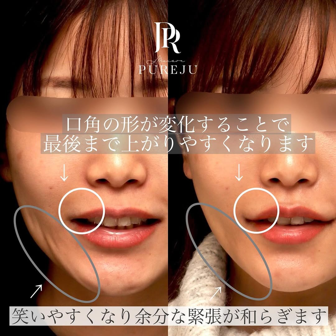 口角挙上で笑いやすく笑顔が綺麗になった症例 画像2
