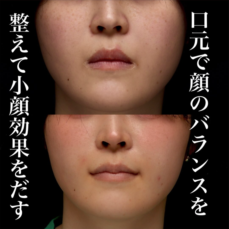 M字リップ＋口角挙上で唇の黄金比を整え小顔効果も出した症例（術後5ヶ月・メイクなし）