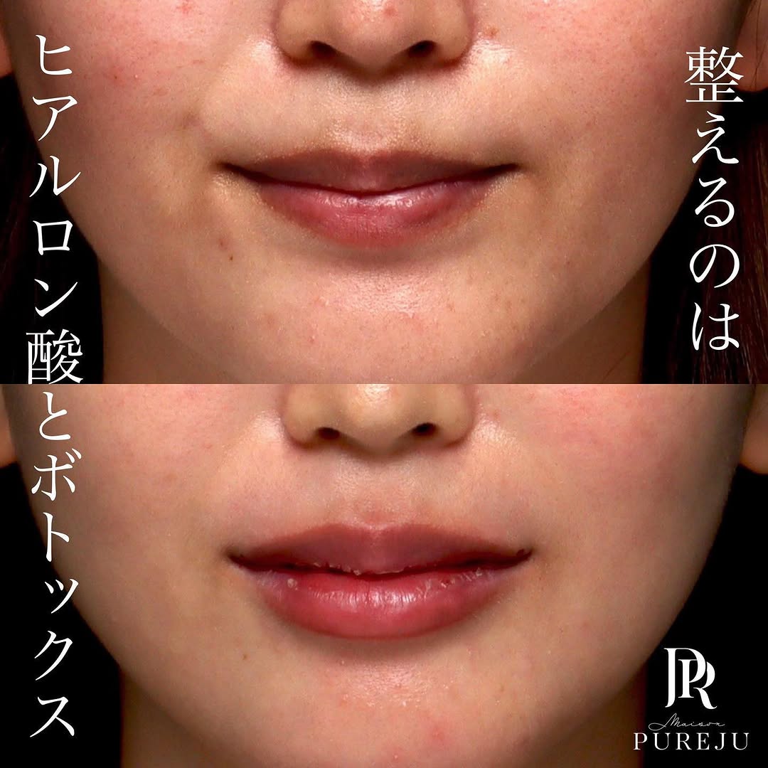 ボトックス×ヒアルロン酸（頬・唇）のトータル注入で上品な印象に整えた症例 画像4