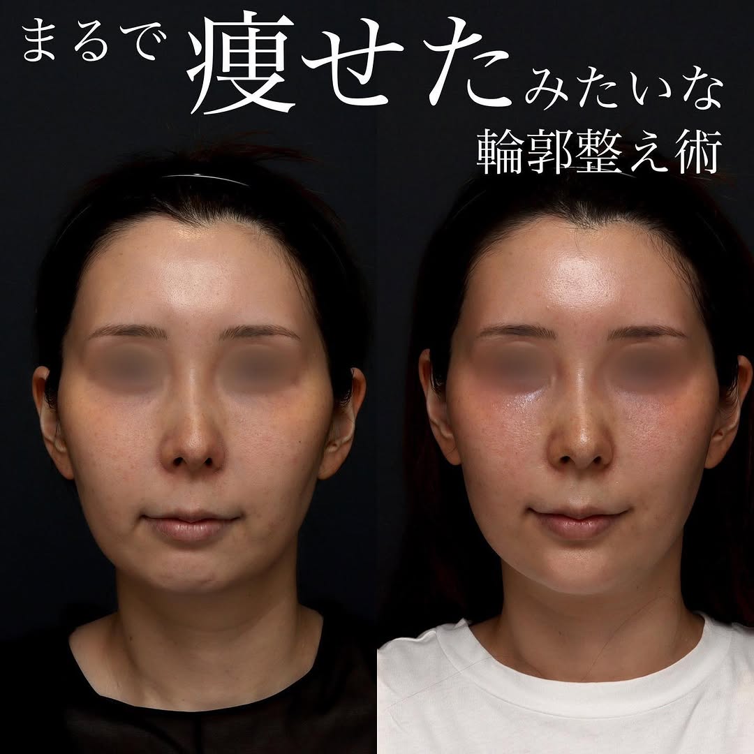 ボトックス×ヒアルロン酸×サーマジェンのコンビネーション治療で下顔面を整えた症例 画像4
