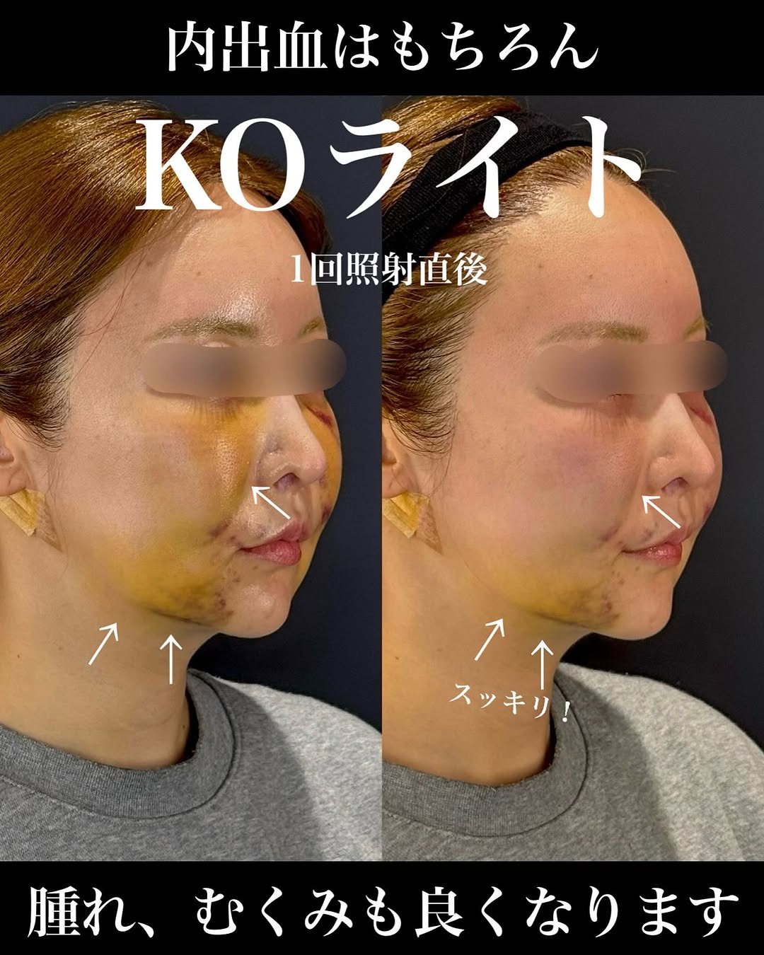 KOライトでゴールデンウィーク手術後の腫れと内出血を軽減したダウンタイム対策症例 画像4