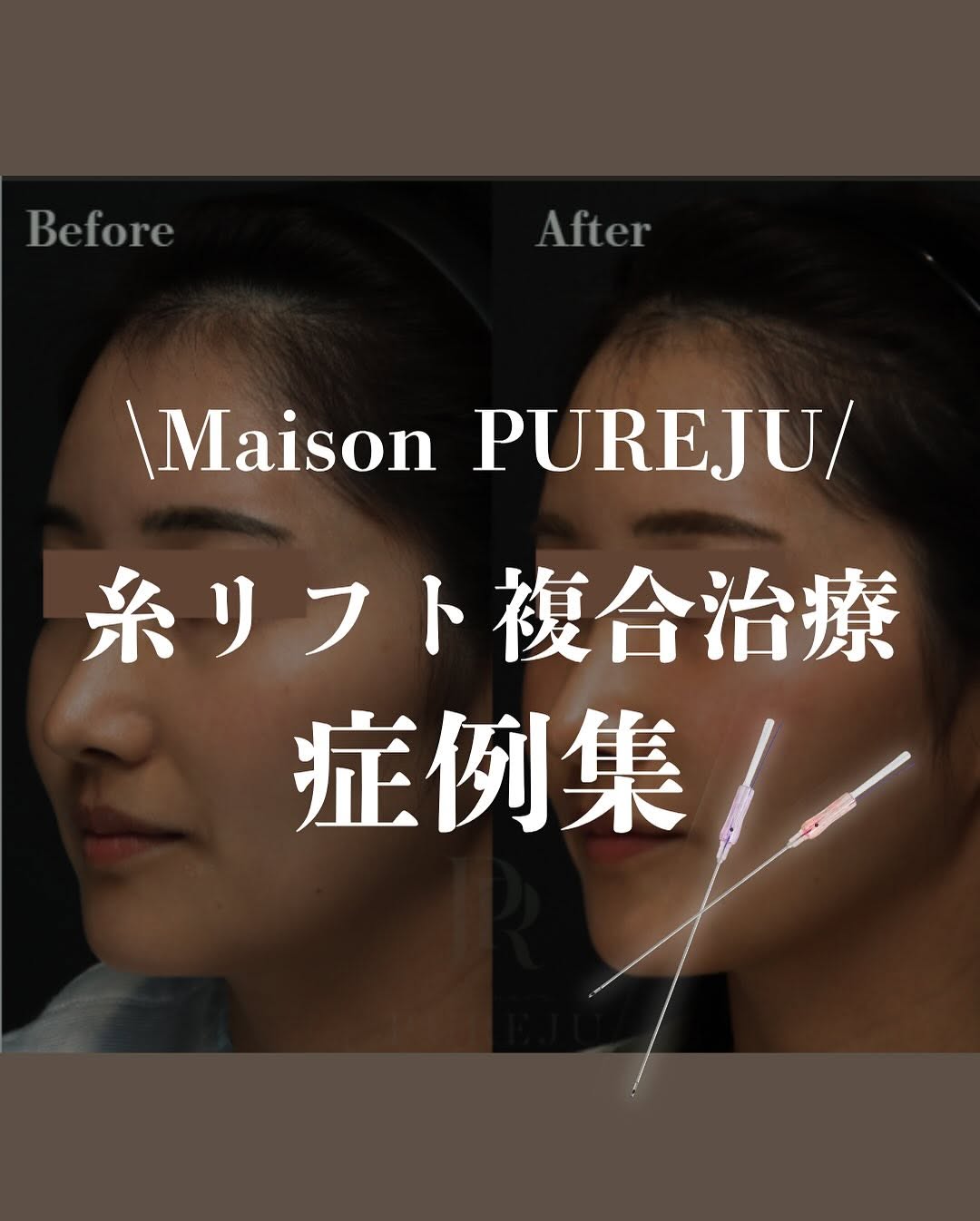 糸リフト×複合治療｜ヒアルロン酸・RF・ショートスレッド・脂肪溶解を組み合わせた輪郭美の作り方