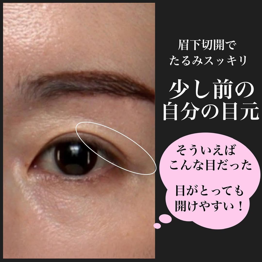 眉下切開で少し昔の自分に戻るアンチエイジング効果を実感した症例 画像4