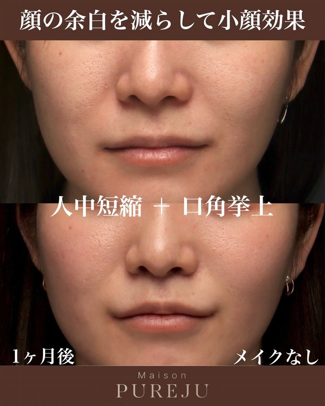 人中短縮＋口角挙上で顔の余白を大幅に減らし小顔効果を実現した症例