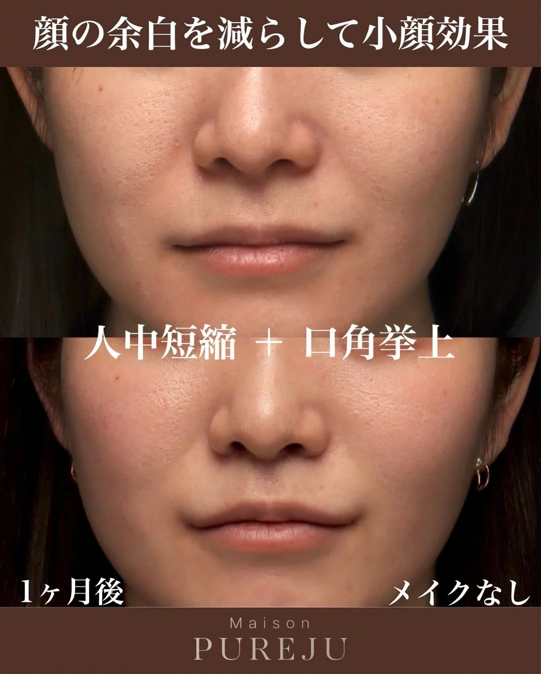 人中短縮+口角挙上で顔の余白を大幅に減らし小顔効果を実現した症例