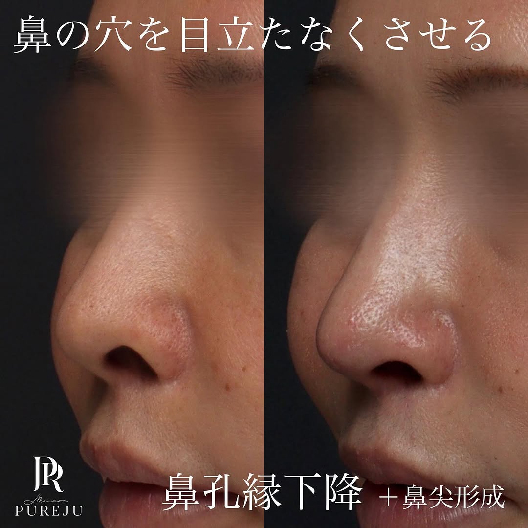 鼻孔縁下降＋鼻尖形成＋耳介軟骨移植で鼻の穴の目立ちを改善した症例