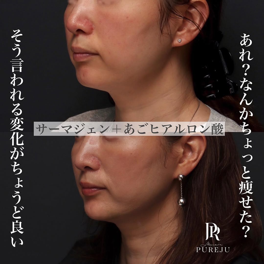 サーマジェン（RF）×あごヒアルロン酸でフェイスラインをすっきり整えた症例