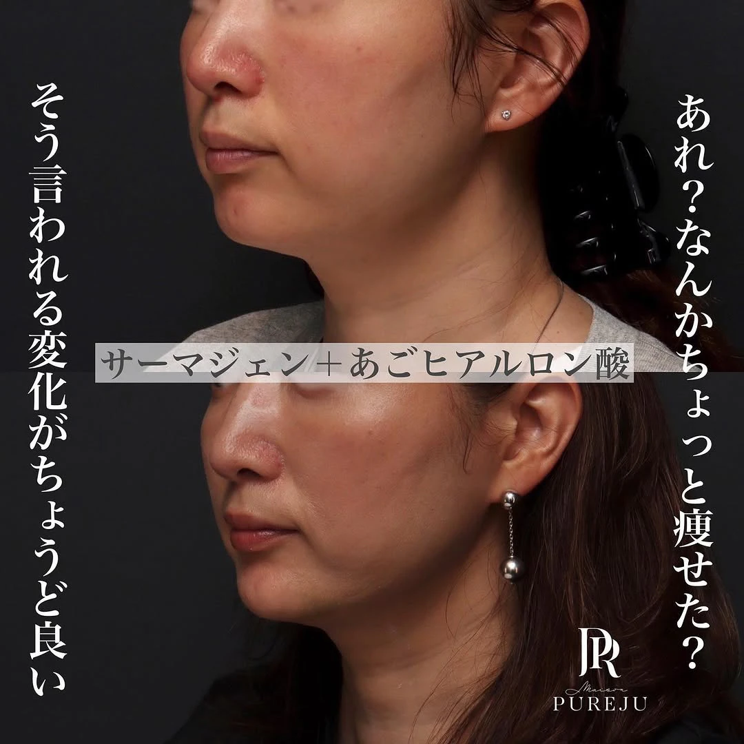 サーマジェン(RF)×あごヒアルロン酸でフェイスラインをすっきり整えた症例