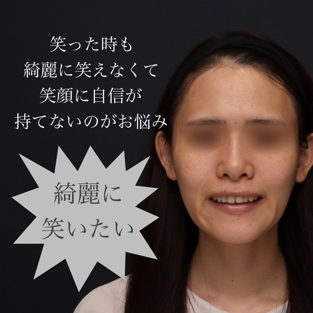 口角形成で笑顔がきれいになりぎこちなさが改善した症例 画像2