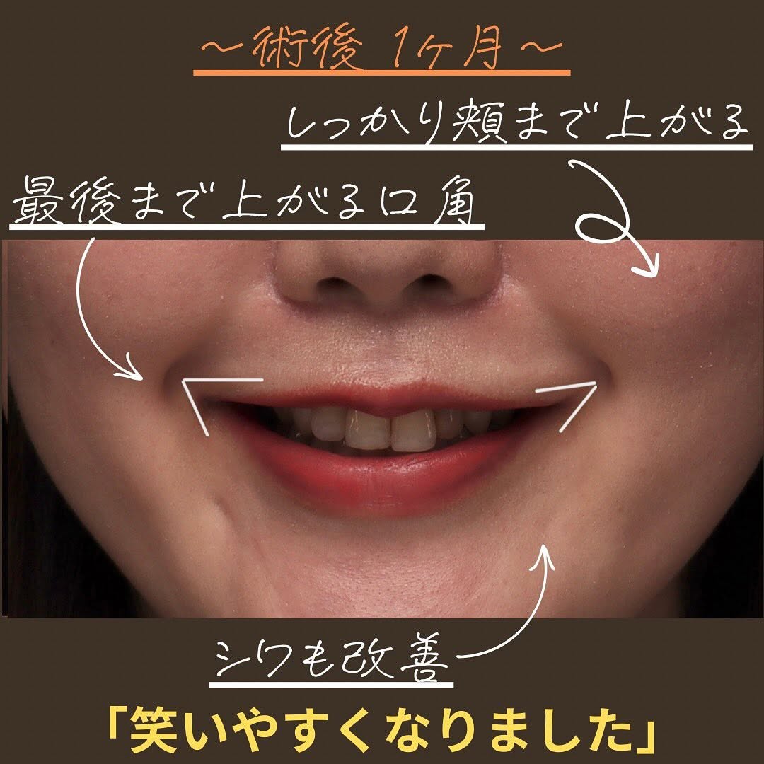 口角挙上で笑いにくさを改善しより魅力的な笑顔になった症例 画像3