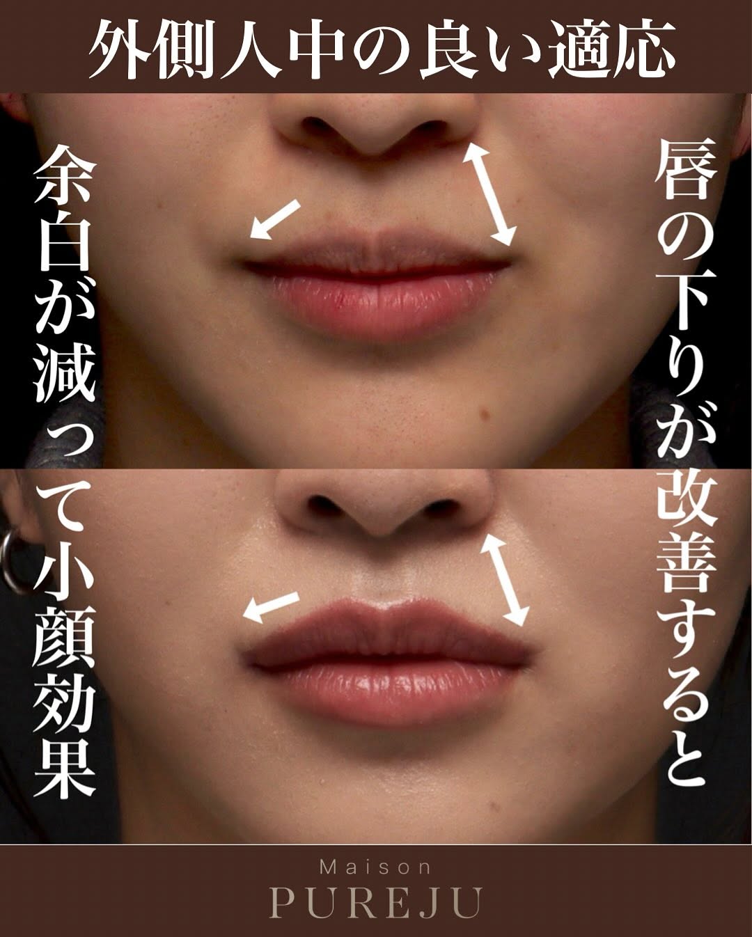 外側人中手術で唇の外側の下りを改善しお顔の余白を減らした症例