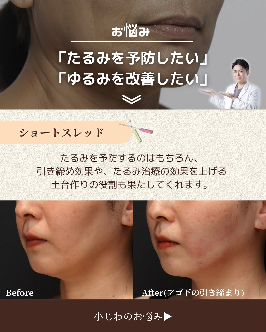お悩み別おすすめ施術4選｜バランス・たるみ予防・皮だるみ・ツヤ肌それぞれに最適な治療とは 画像3