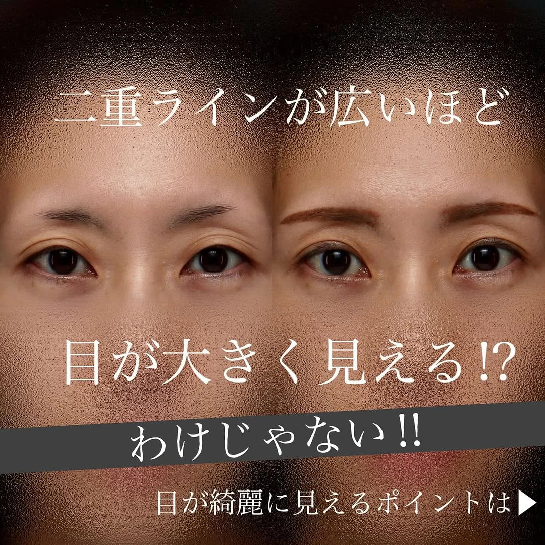 二重幅と自然な二重ラインを意識した二重埋没でまつ毛が上向きにきれいに出た症例