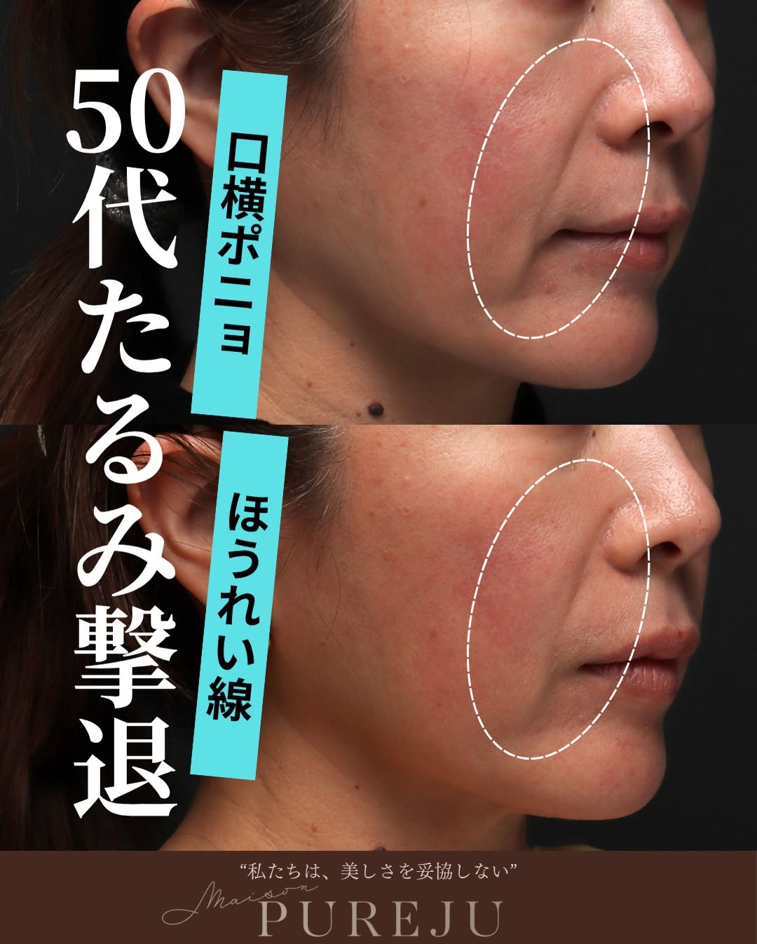 50代のたるみにはWアプローチが効果的｜XERF×ウルトラセルZiの組み合わせ治療