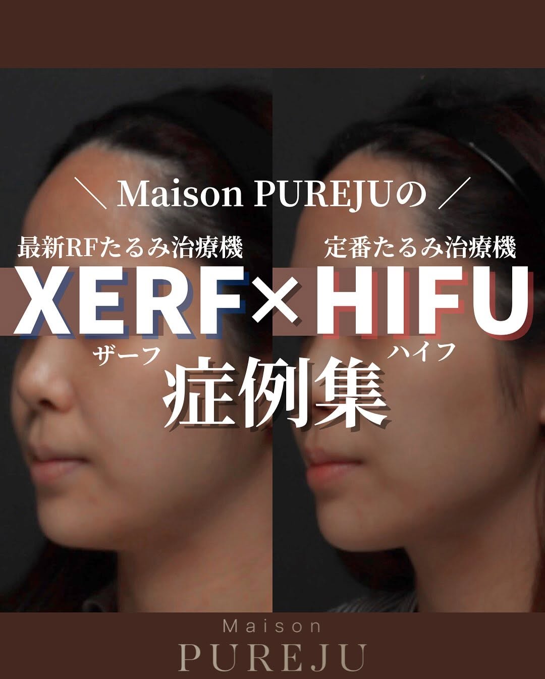 XERF（ザーフ）×HIFU（ハイフ）｜2種の周波数と超音波を組み合わせた全層たるみ治療の仕組みと症例