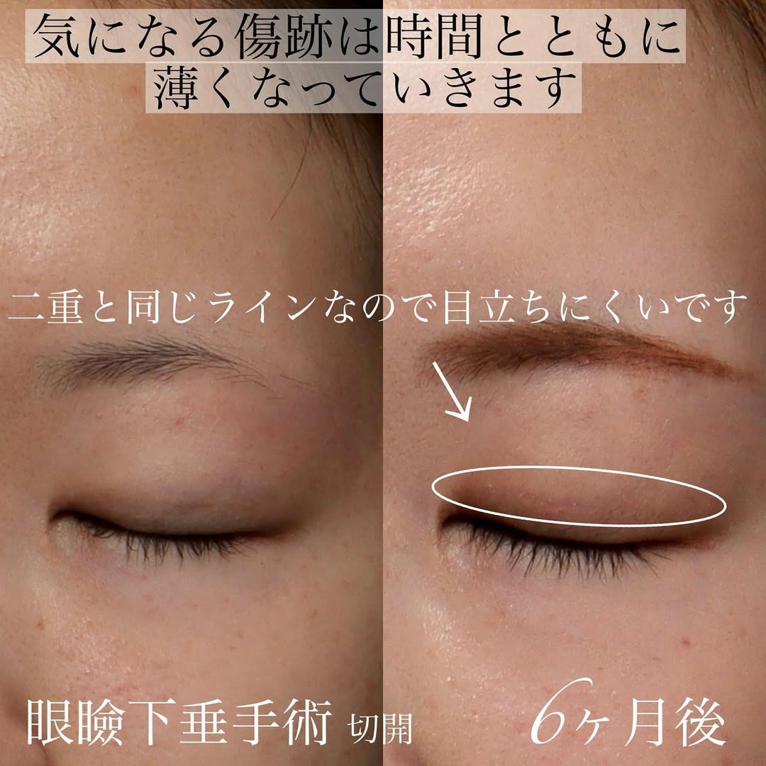 眼瞼下垂手術で黒目全体が見えるようになり目の開きと印象を改善した症例 画像4