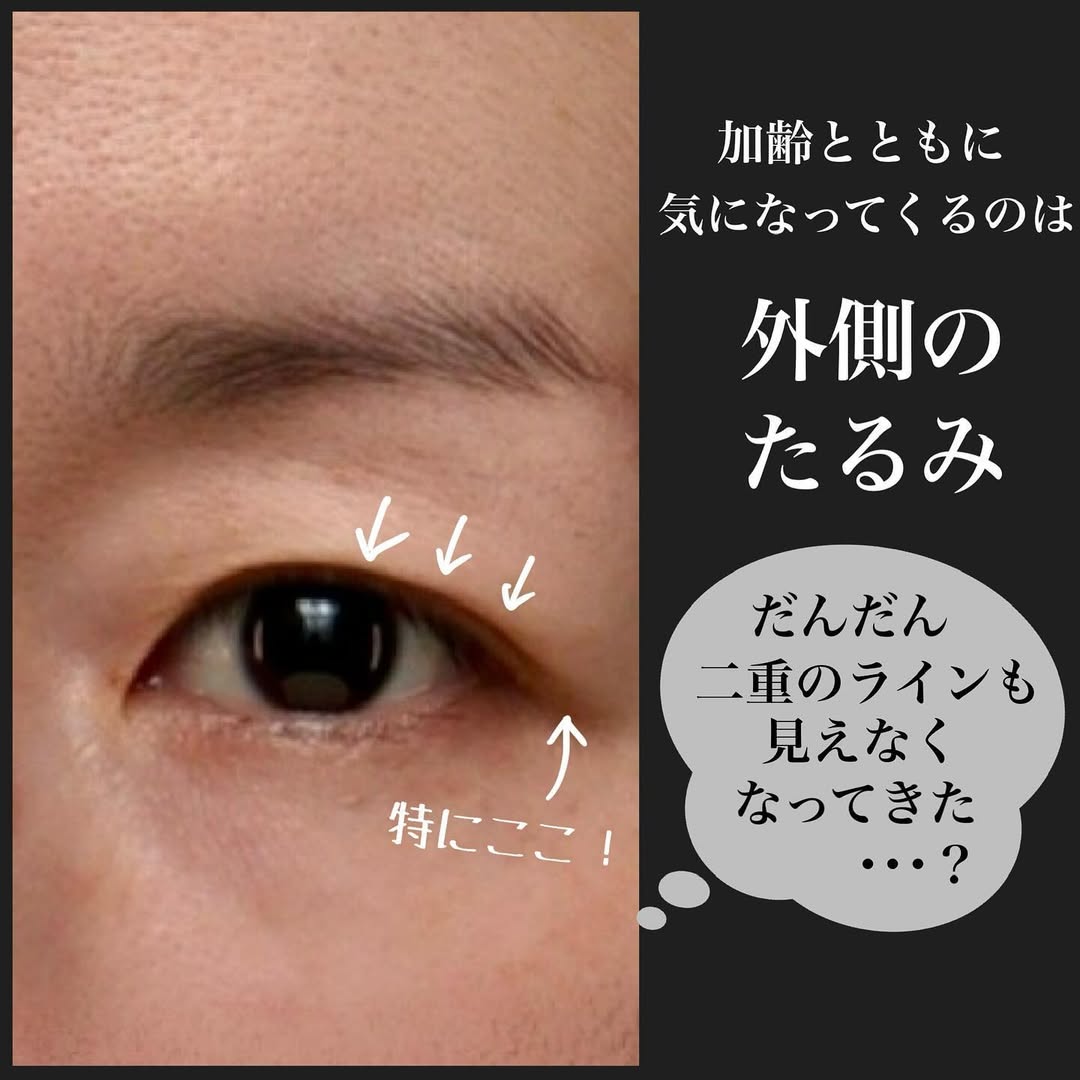眉下切開で少し昔の自分に戻るアンチエイジング効果を実感した症例 画像3