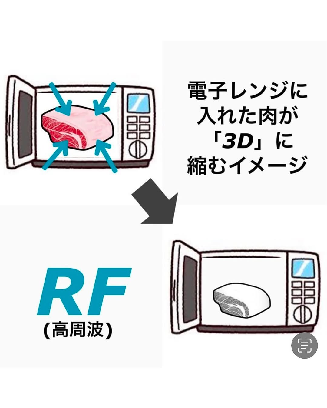 ウルトラセルZi（HIFU）＋ザーフ（RF）の組み合わせでたるみを全層引き締めた症例 画像4