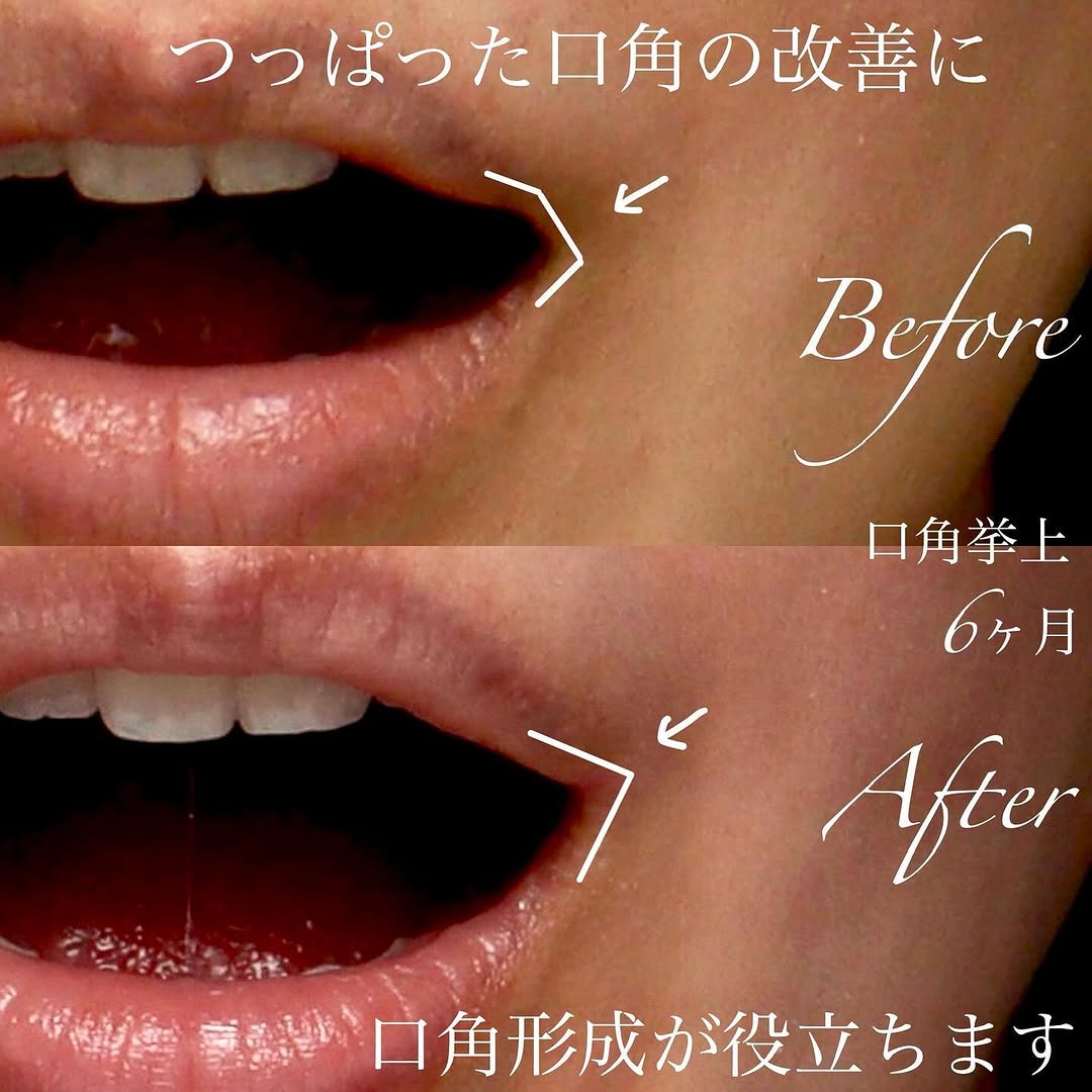 口角挙上の傷跡が目立ちにくい理由と口角形成の変化を示した症例 画像2