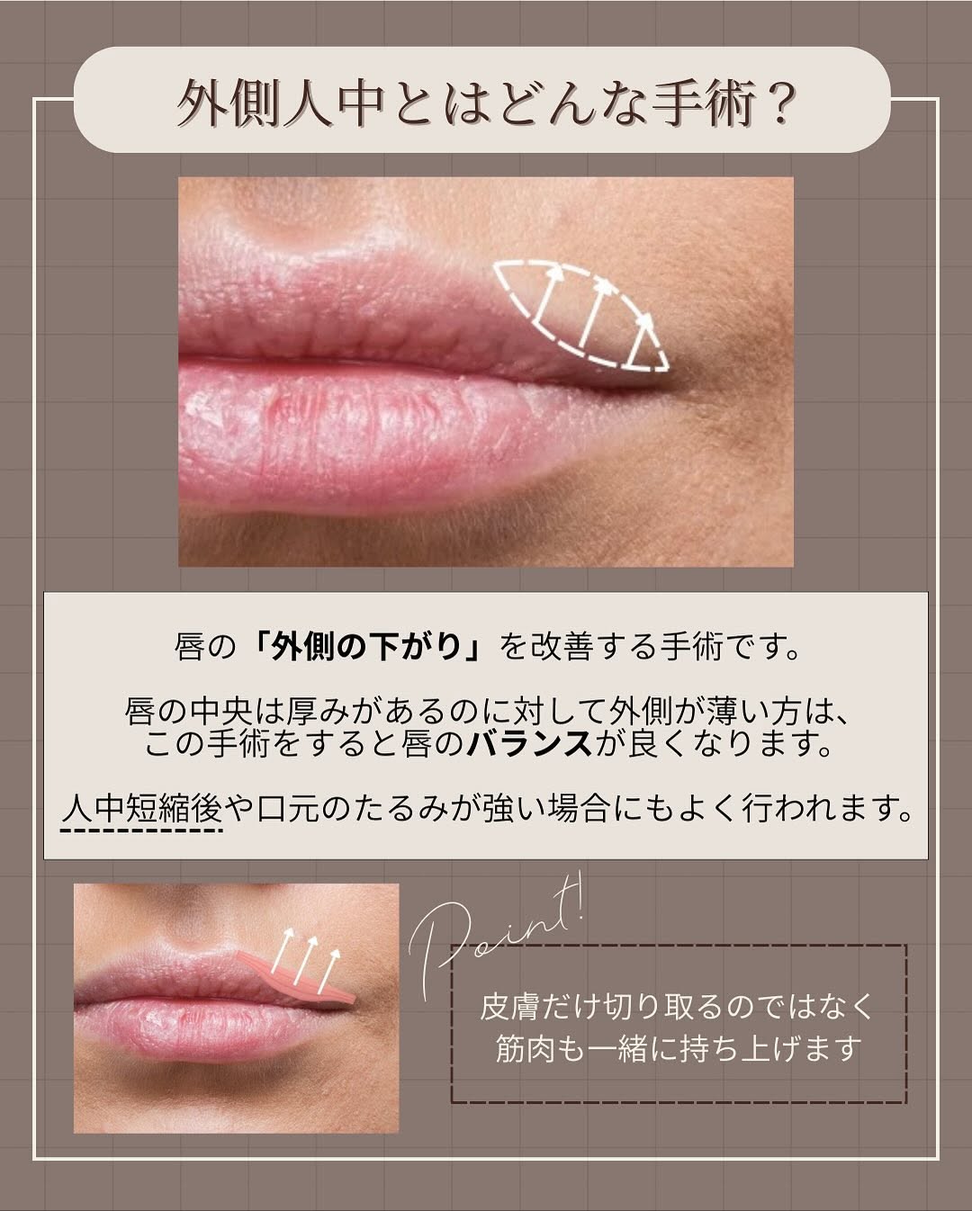 外側人中の傷跡が目立ちにくい位置と形成外科的なこだわりを示した症例 画像2