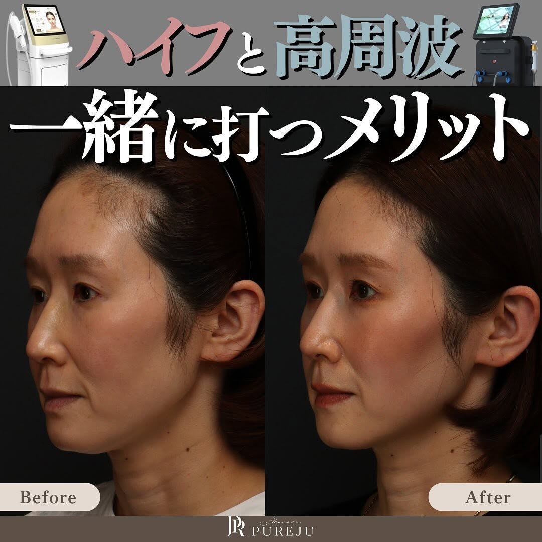 ハイフ×高周波（サーマZI）を組み合わせるメリット｜全層に熱を加える立体たるみ治療