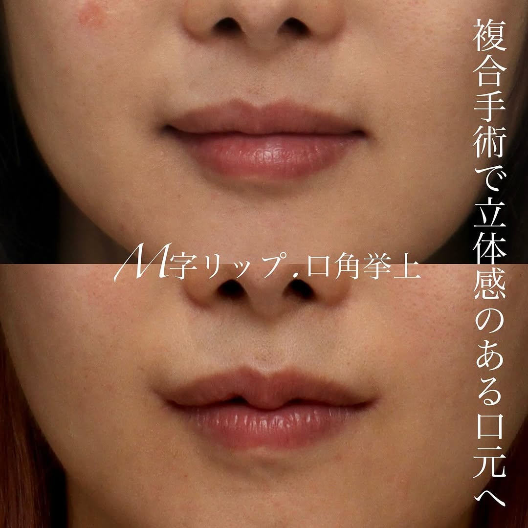 口角挙上＋M字リップの複合手術でより女性らしい立体的な唇に整えた症例