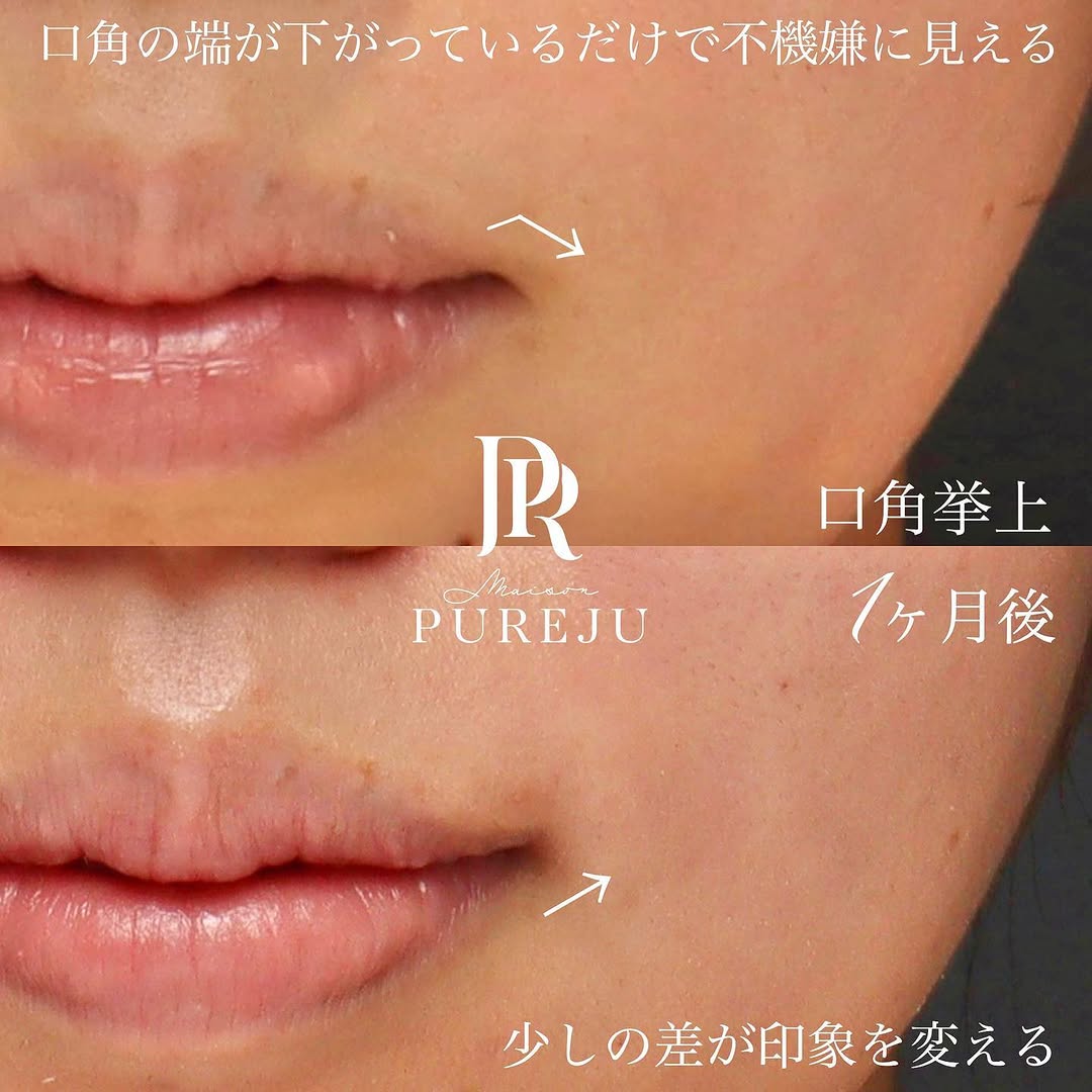 口角挙上でナチュラルに口角を上げ「不機嫌そう」な印象を改善した症例（術後1ヶ月） 画像2