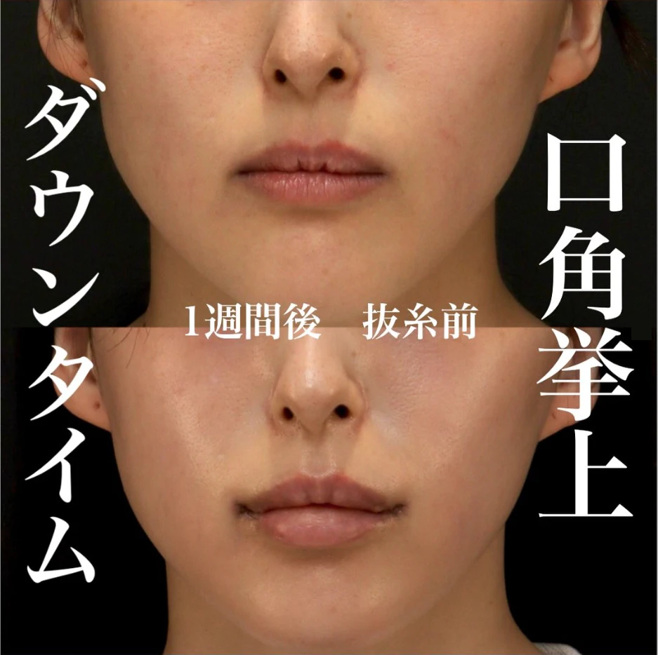 口角挙上のダウンタイム経過、抜糸前でも縫合糸が目立ちにくい症例(術後1週間)