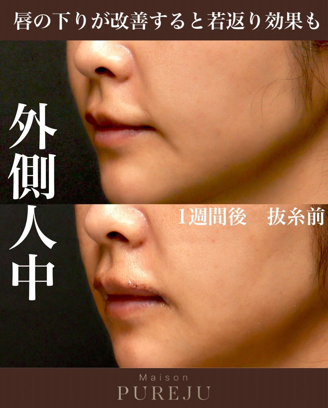 外側人中手術で唇のバランスを立体的に改善し口元の印象を整えた症例 画像2