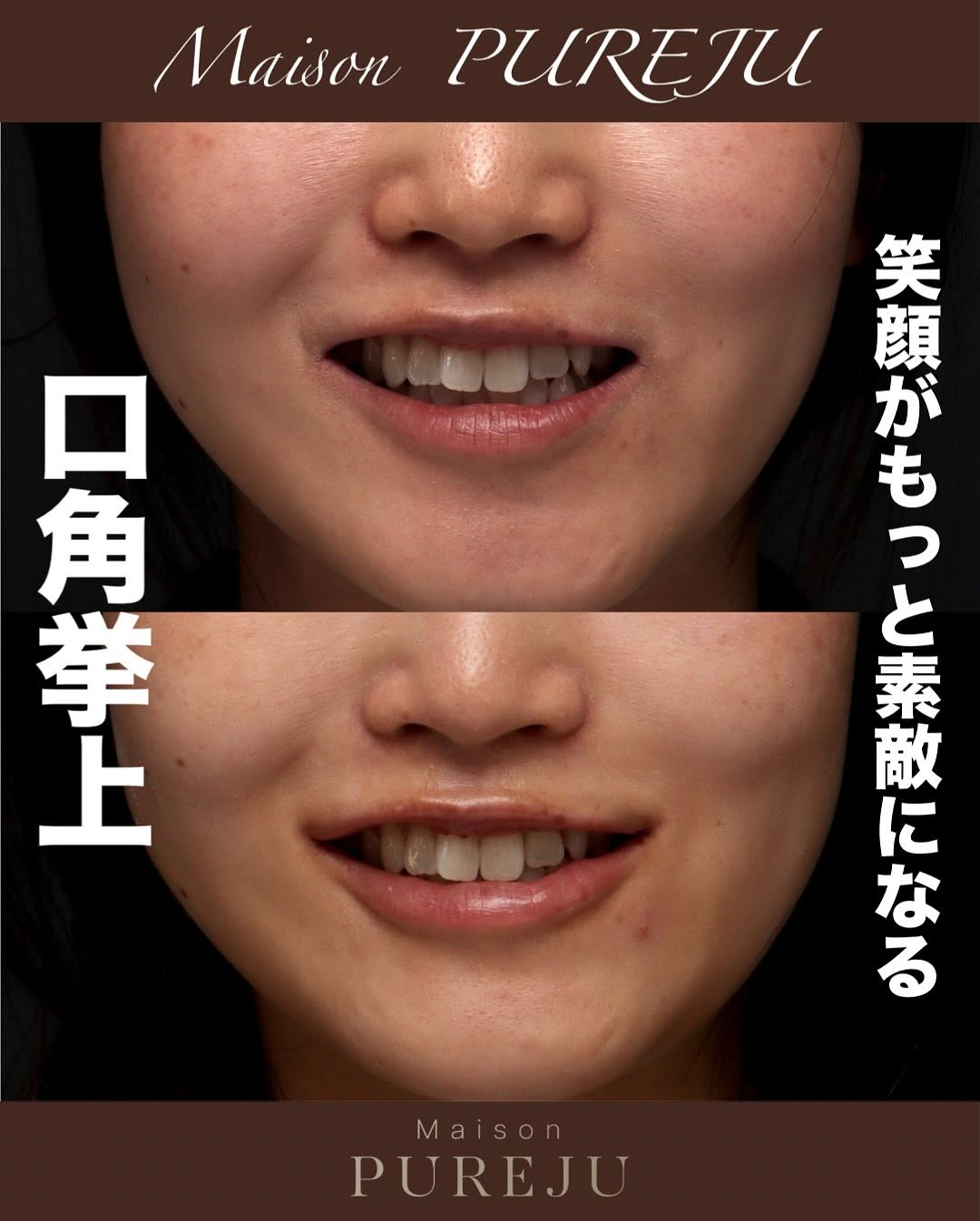 口角挙上＋ヒアルロン酸で笑顔が良くなり唇のバランスも整えた症例