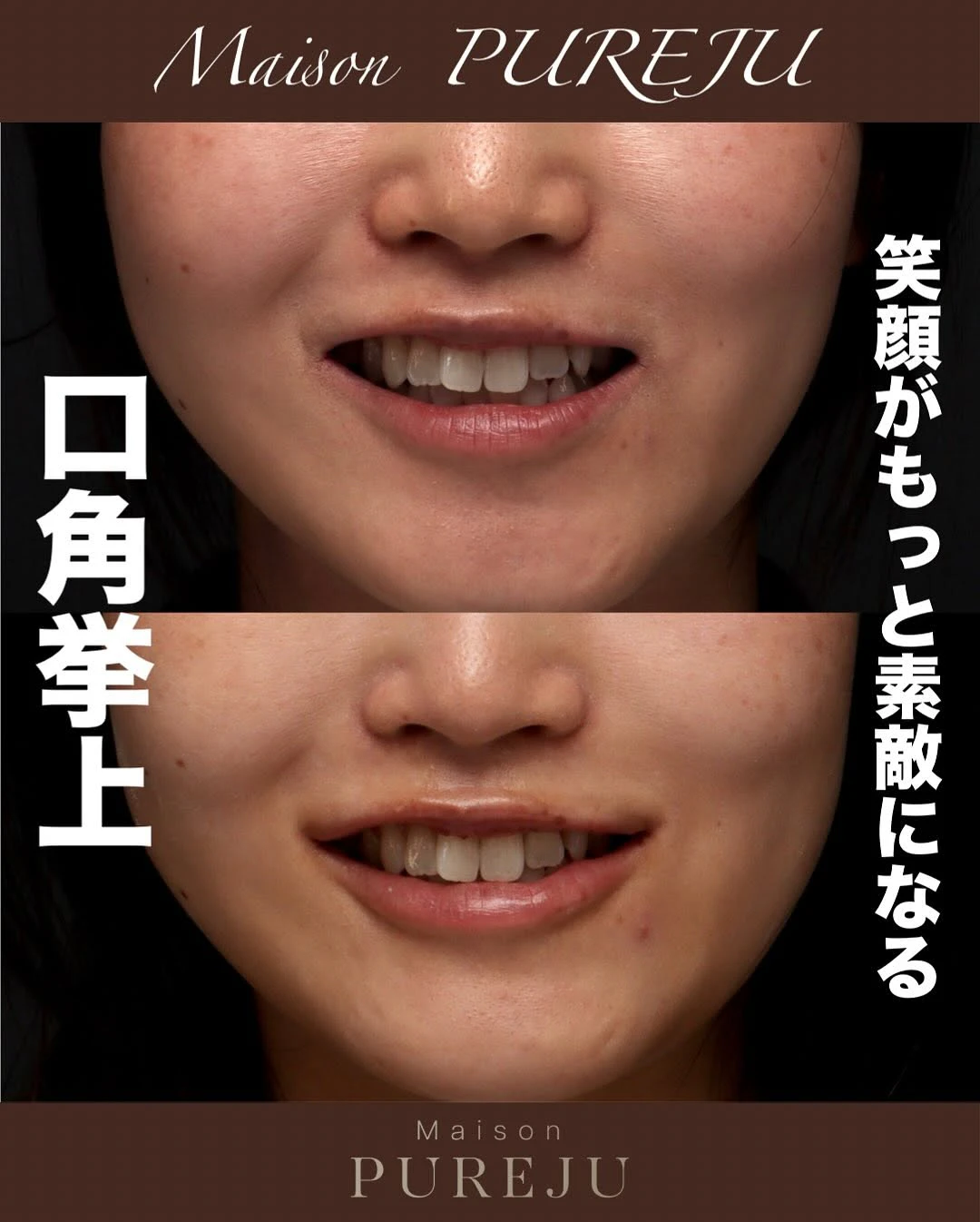 口角挙上+ヒアルロン酸で笑顔が良くなり唇のバランスも整えた症例