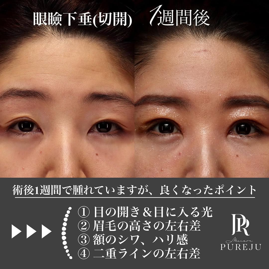 眼瞼下垂手術（切開法）で目の開きと眉の左右差を改善した症例（術後1週間）