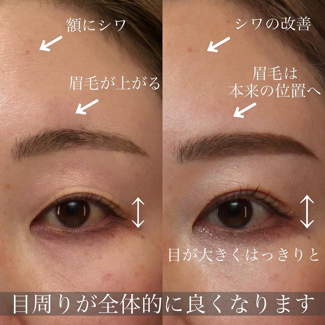 眼瞼下垂の切開法・埋没法の違いと手術の変化を解説した症例 画像3