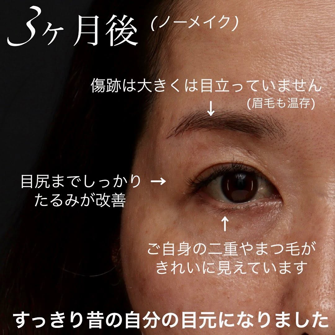 眉下切開で埋もれた二重とまつ毛を復活させ昔の目元に戻した症例（術後3ヶ月） 画像3