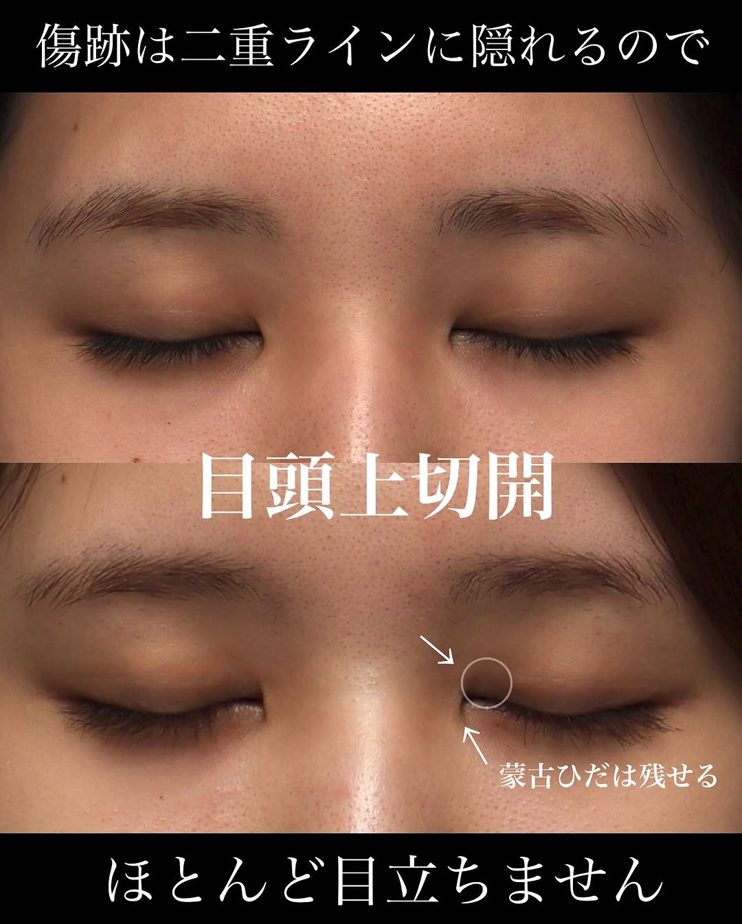 目頭上切開で目頭側のたるみを改善しどこから見てもすっきりした丸い目元に整えた症例 画像5