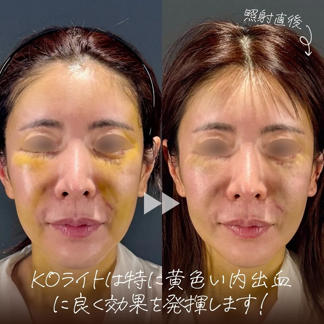 KOライトで術後の腫れと黄色い内出血を素早く改善したダウンタイム対策症例 画像2