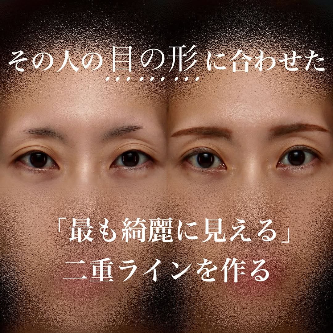 二重幅と自然な二重ラインを意識した二重埋没でまつ毛が上向きにきれいに出た症例 画像4