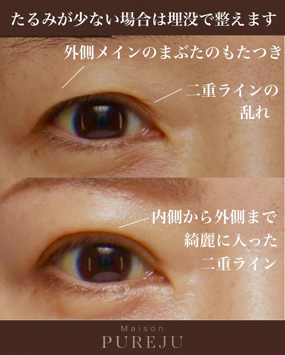 二重埋没で乱れた二重ラインと左右差を改善した症例 画像2