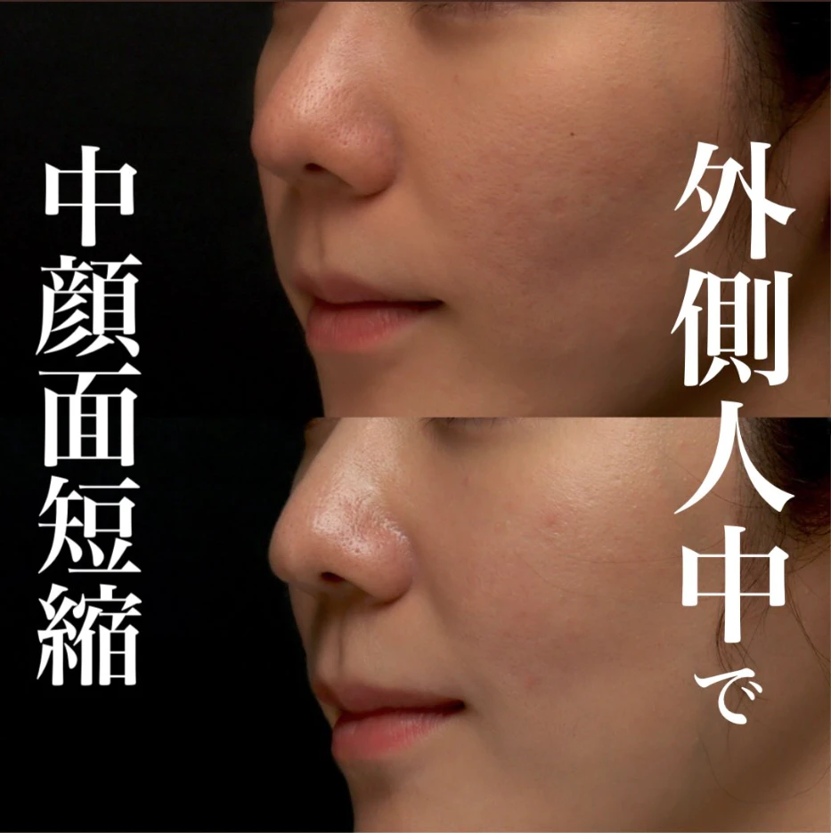 外側人中短縮で唇の下がりを改善し中顔面を短く見せた症例(術後3ヶ月・メイクなし)