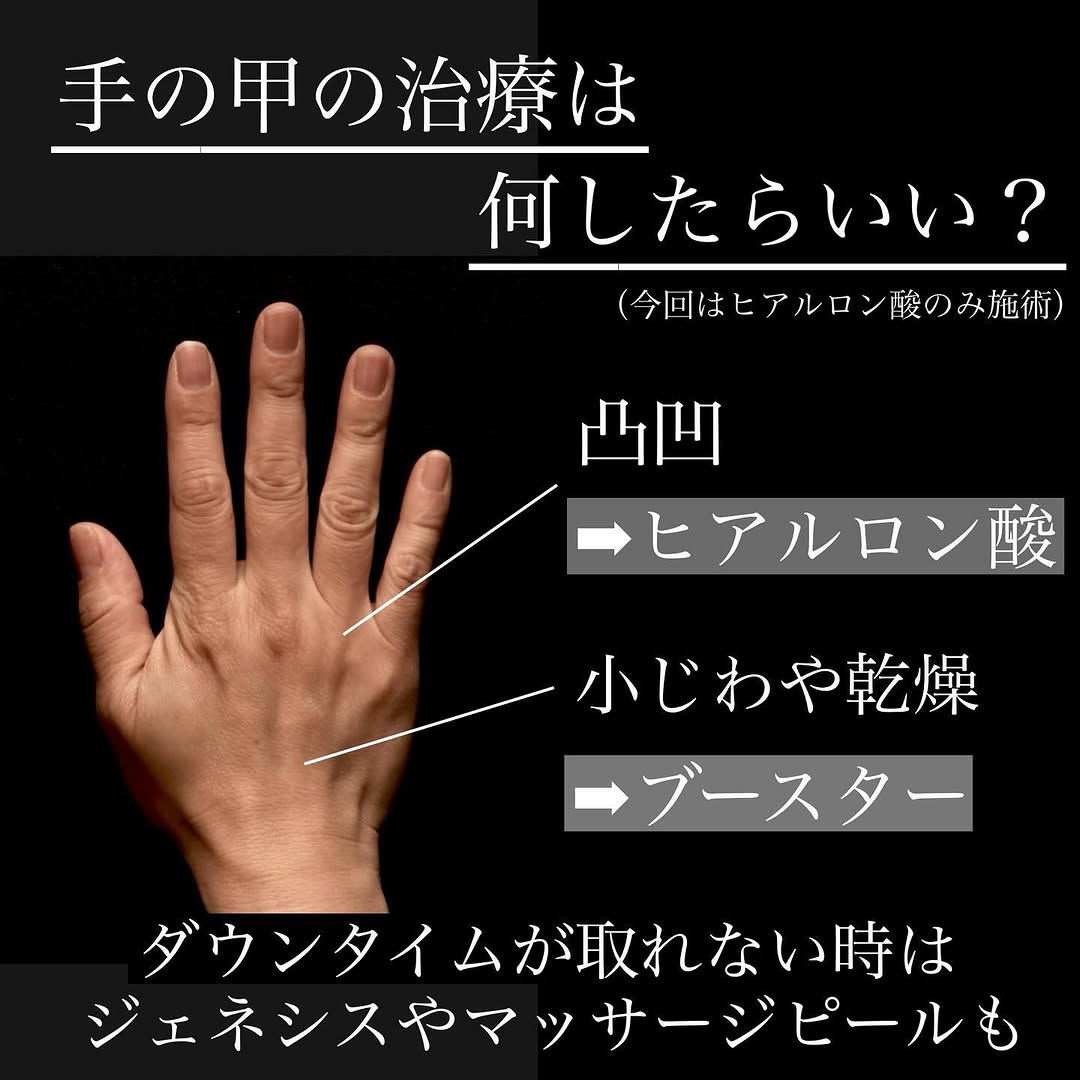 手の甲へのヒアルロン酸注射でふっくら若々しい手元に整えた症例 画像2