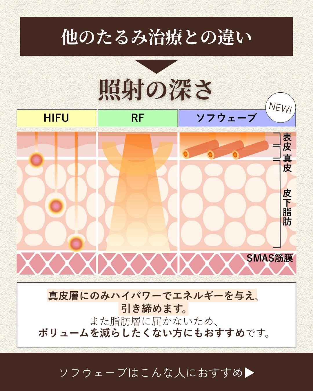 厚生労働省承認機ソフウェーブで小じわとたるみを改善した症例 画像3