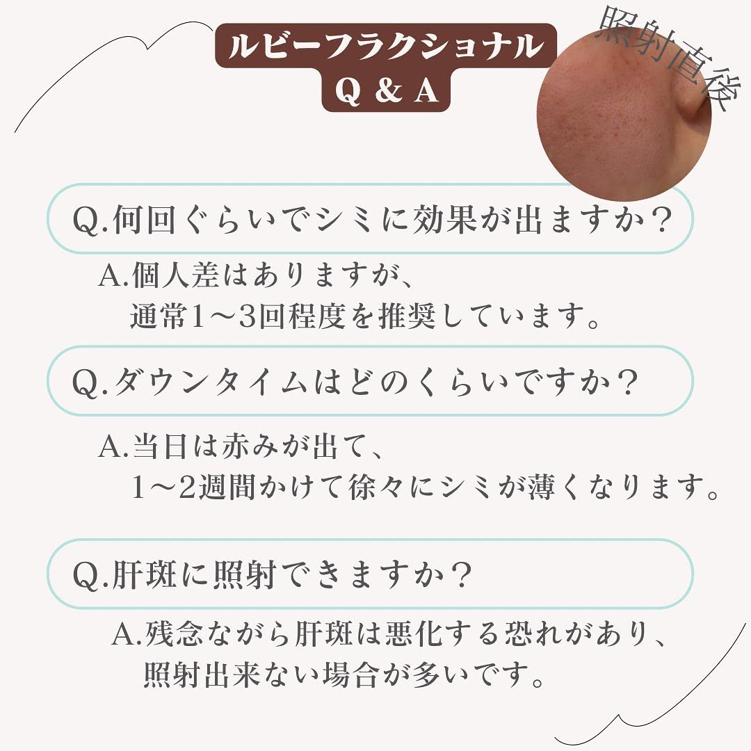 ルビーフラクショナルとは｜光治療で消えないシミ・ADMをダウンタイム短めで改善 画像4